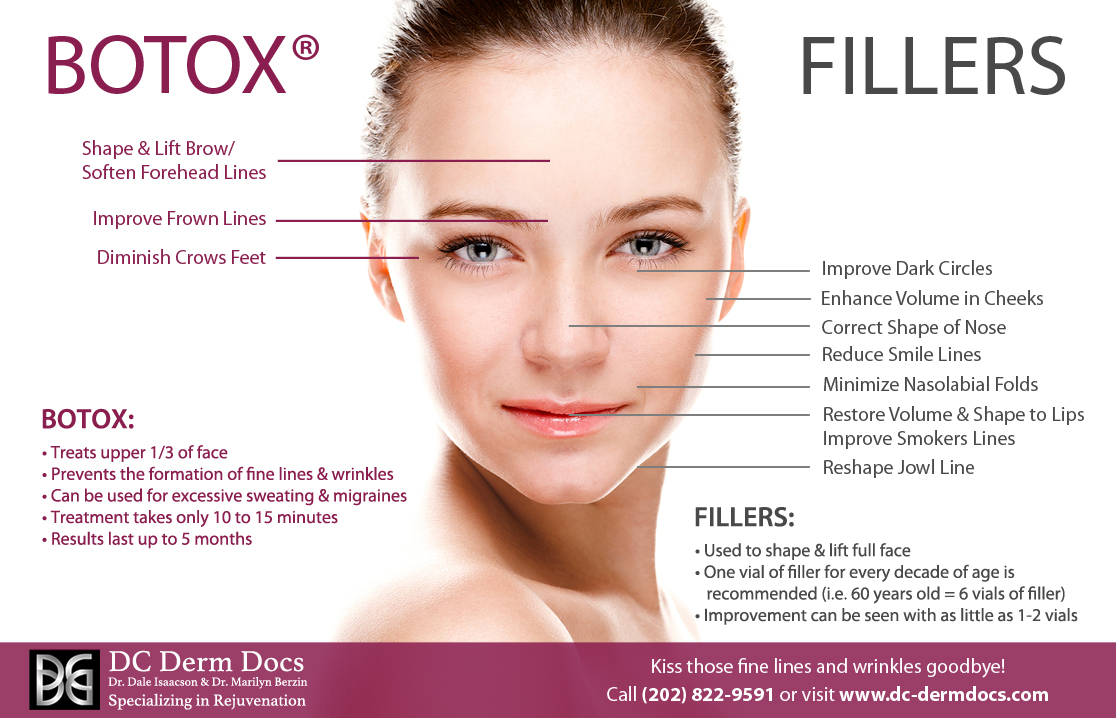 BotoxFillersInfographic 4 1